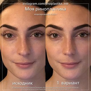 One of the top publications of @rinoplastika_me which has 2K likes and 48 comments